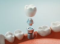 an illustration showing a dental implant restoration being placed 