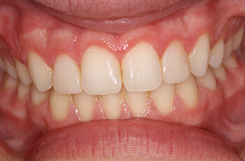 after porcelain veneers