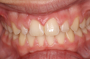 before porcelain veneers