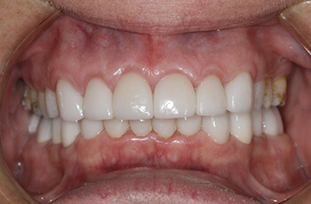 porcelain veneers restoration after