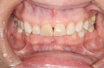 before porcelain veneer restorations