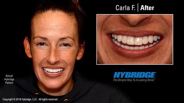 Patient after Hybridge