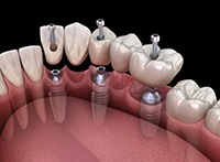 Illustration of implant bridge