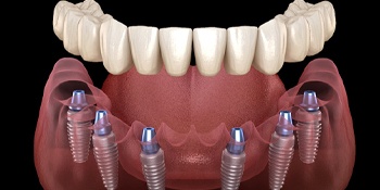 Implant dentures