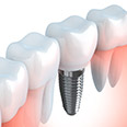 graphic of implant