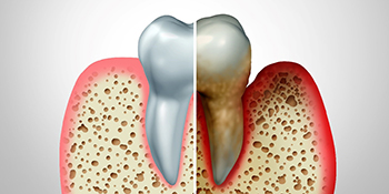 Side by side illustration showing healthy gums vs diseased gums