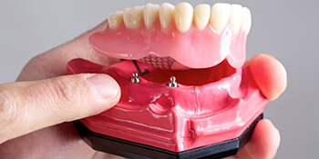Implant-supported dentures