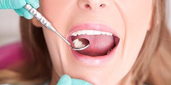 Close-up of mouth while dentist checks for gum disease symptoms