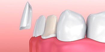 Model of veneer for lower tooth