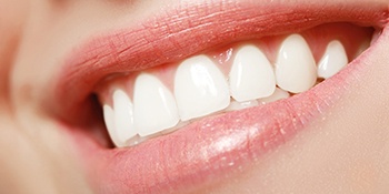 Woman’s teeth with veneers