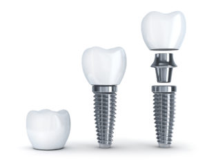 dental implant 3d model 