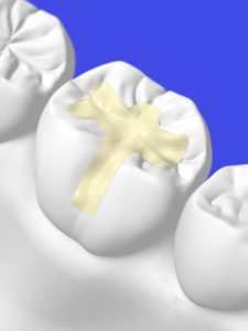 digital model of white fillings