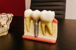 Model of dental implant for jawbone preservation.