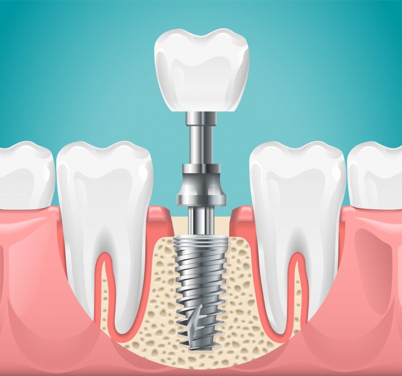 Illustration of a loose dental implant