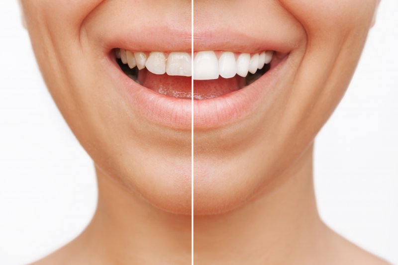 a before/after shot of a cosmetic dental patient’s smile