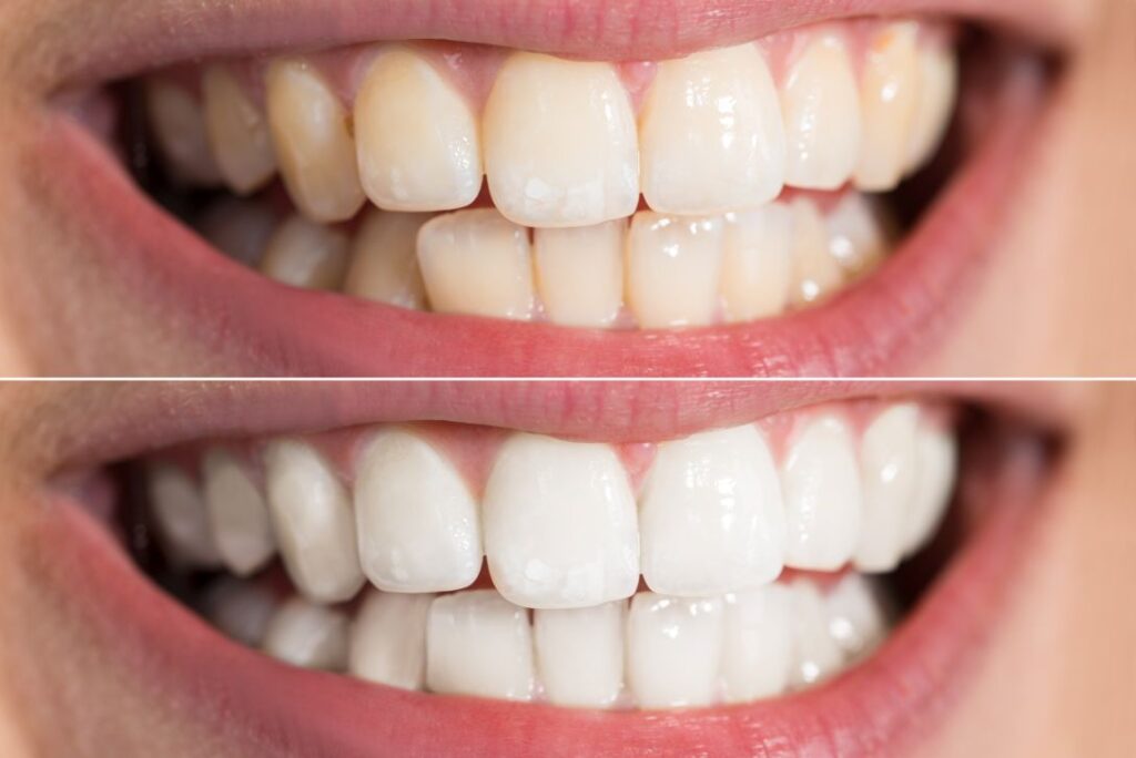 A smile before and after teeth whitening